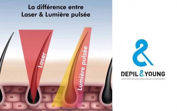 Depil&Young : avantages de l’épilation à la lumière pulsée vs le laser